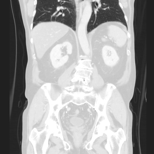 Cecal volvulus (Radiopaedia 75378-86620 Coronal lung window 93).jpg