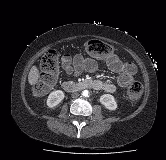 Celiac artery severe stenosis and dissection (Radiopaedia 44128-47842 B 48).jpg