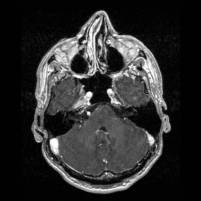File:Central-variant posterior reversible encephalopathy syndrome (PRES) (Radiopaedia 43880-47358 Axial T1 C+ 33).jpg