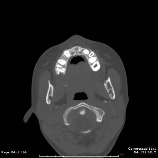 File:Central giant cell granuloma (Radiopaedia 45612-49754 Axial bone window 42).jpg