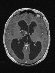 Central neurocytoma (Radiopaedia 56690-63469 Axial T1 C+ 81).jpg