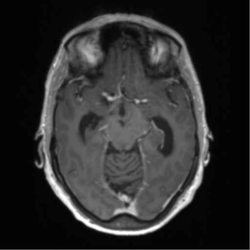 Central neurocytoma (Radiopaedia 65317-74345 Axial T1 C+ 19).png