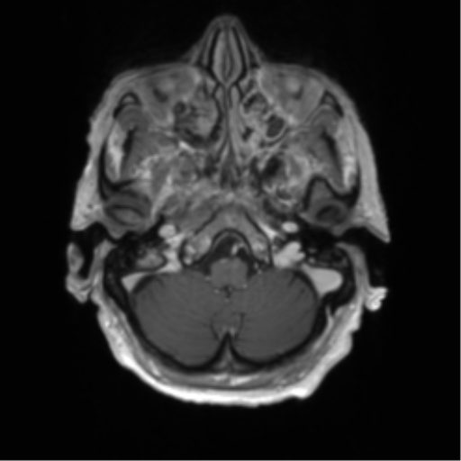 Central neurocytoma (Radiopaedia 65317-74345 Axial T1 C+ 3).png