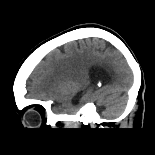 File:Central neurocytoma (Radiopaedia 65317-74346 C 17).png
