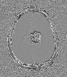 Central neurocytoma (Radiopaedia 84497-99872 Axial 46).jpg