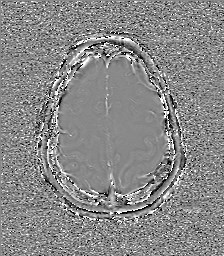 Central neurocytoma (Radiopaedia 84497-99872 Axial 59).jpg