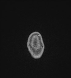 Central neurocytoma (Radiopaedia 84497-99872 Axial T1 C+ 153).jpg