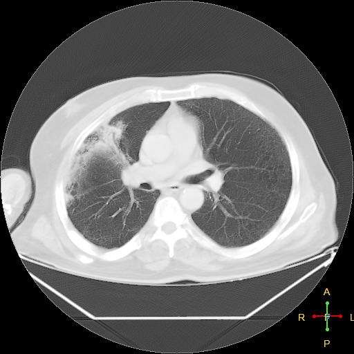 File:Centrilobular emphysema - with superimposed infection (Radiopaedia 24389-24683 lung window 14).jpg