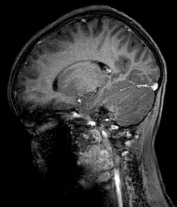 Cerebellar abscess (Radiopaedia 73727-84563 J 42).jpg