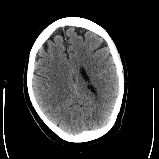Cerebellar abscess (Radiopaedia 78135-90671 Axial non-contrast 72).jpg