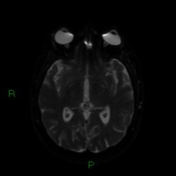 Cerebellar abscess (Radiopaedia 78135-90678 Axial DWI 45).jpg