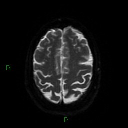 Cerebellar abscess (Radiopaedia 78135-90678 Axial DWI 53).jpg