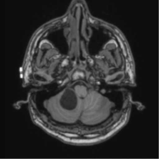 Cerebellar hemangioblastomas and pituitary adenoma (Radiopaedia 85490-101176 Axial T1 13).png