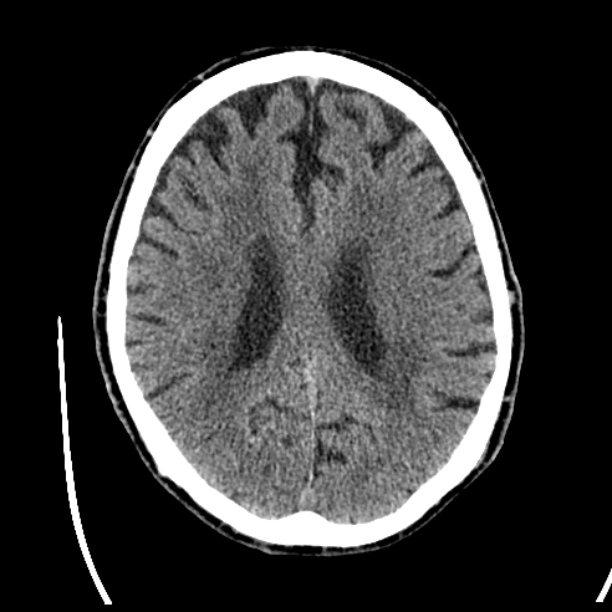 Cerebellar hemorrhage (Radiopaedia 27193-27359 Axial non-contrast 33).jpg