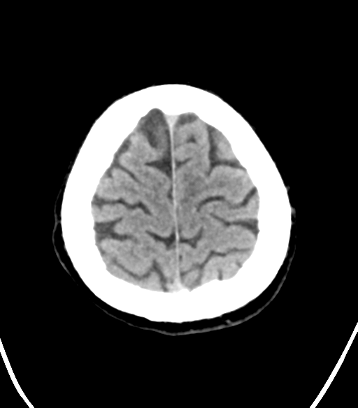 File:Cerebellar hemorrhage (Radiopaedia 37000-38669 Axial non-contrast 34).png
