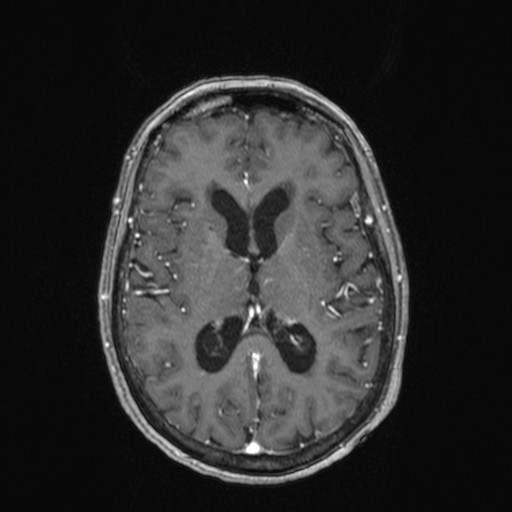 Cerebellar metastases (Radiopaedia 24038-24249 Axial T1 C+ 11).jpg