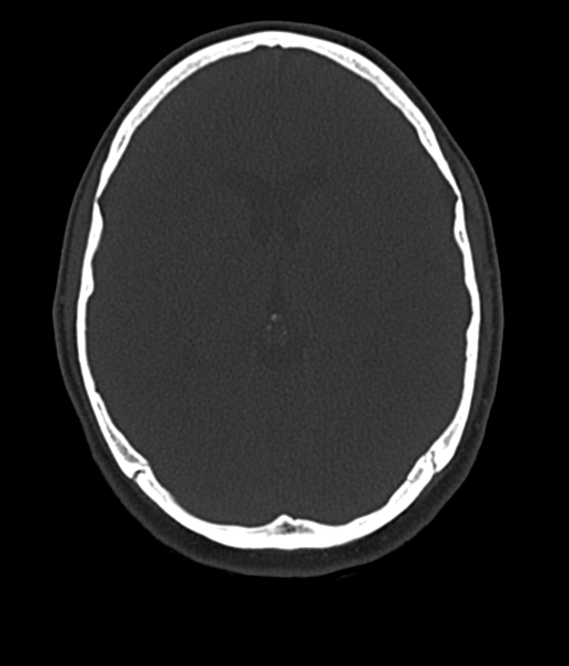 File:Cerebellar metastases - colorectal adenocarcinoma (Radiopaedia 40947-43652 AX Bone C- 2.0 MPR 30).png