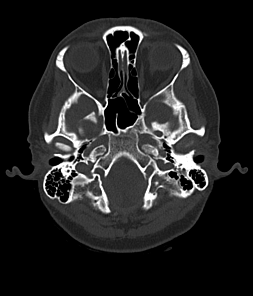 Cerebellar metastases - colorectal adenocarcinoma (Radiopaedia 40947-43652 AX Bone C- 2.0 MPR 8).png