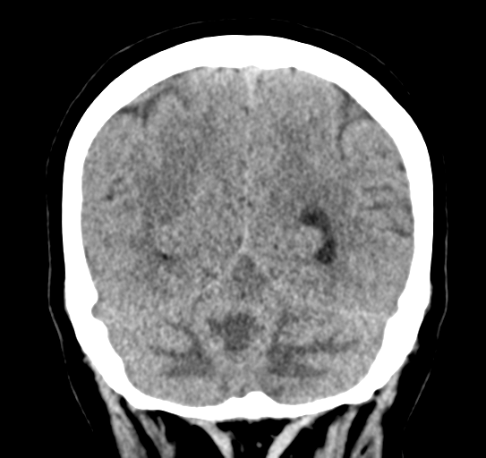 Cerebellar metastasis (Radiopaedia 54578-60812 Coronal non-contrast 46).png