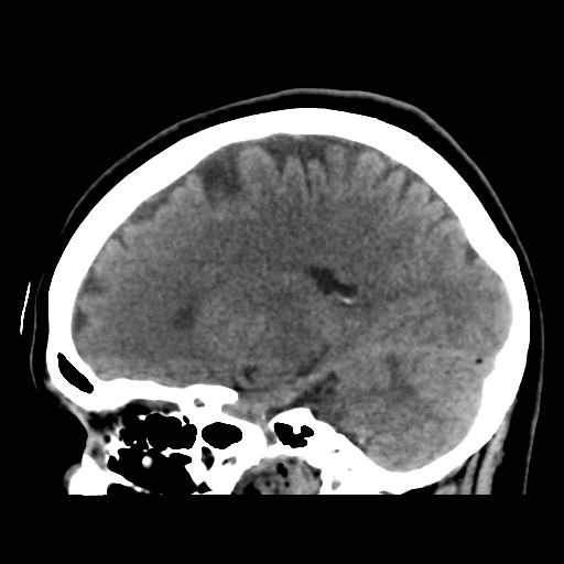 Cerebellar metastasis (cystic appearance) (Radiopaedia 41395-44258 E 35).png