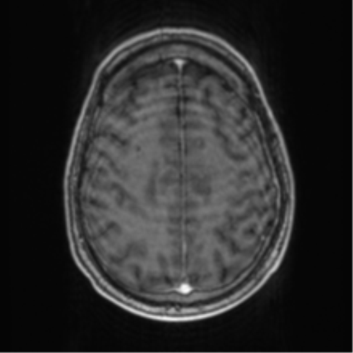 Cerebellar metastasis from lung adenocarcinoma (Radiopaedia 86690-102829 Axial T1 C+ 61).png