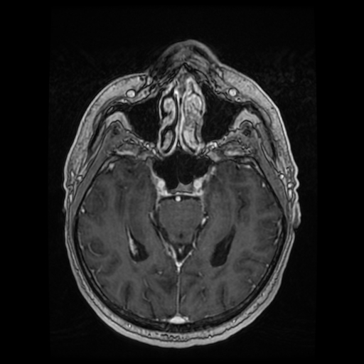 Cerebellar metastasis of pulmonary adenocarcinoma, cavernous venous malformation, and developmental venous anomaly (Radiopaedia 85827-101661 Axial T1 C+ 41).jpg