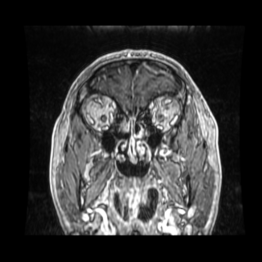 Cerebellar metastasis of pulmonary adenocarcinoma, cavernous venous malformation, and developmental venous anomaly (Radiopaedia 85827-101661 Coronal T1 C+ 78).jpg