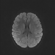 File:Cerebellar stroke (Radiopaedia 32202-33150 Axial DWI 37).png