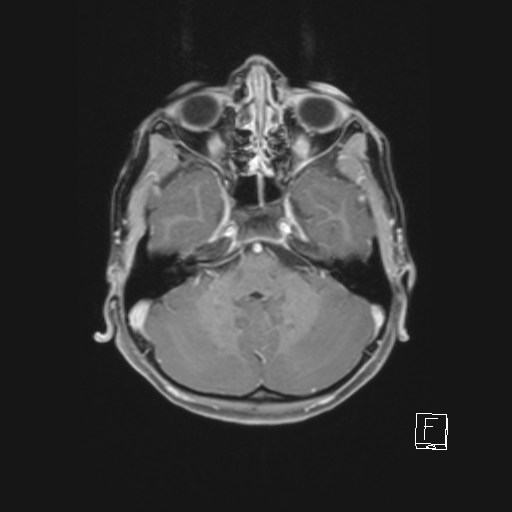 Cerebellar stroke (Radiopaedia 32202-33150 Axial T1 C+ 25).png