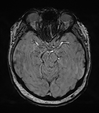 File:Cerebellopontine angle meningioma (Radiopaedia 48434-53348 Axial SWI 36).png