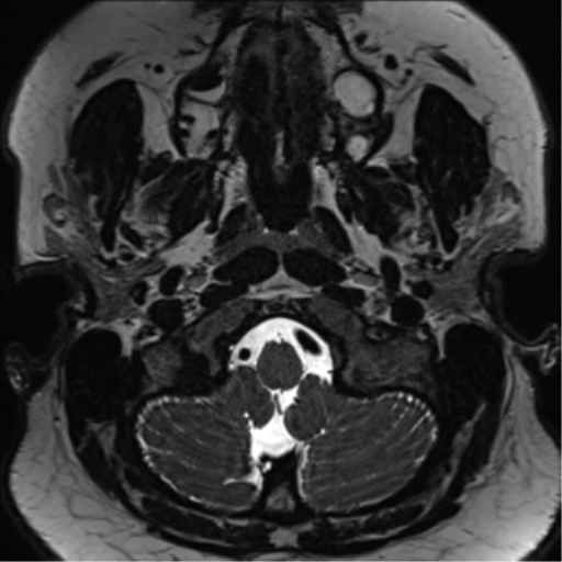 Cerebellopontine angle meningioma (Radiopaedia 48434-53348 Axial T2 Space 8).png