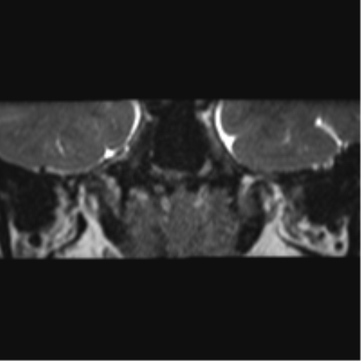 Cerebellopontine angle meningioma (Radiopaedia 48434-53348 Coronal T2 73).png