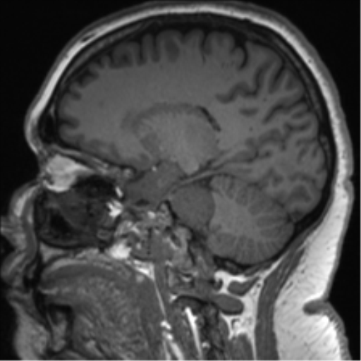 Cerebellopontine angle meningioma (Radiopaedia 48434-53348 Sagittal T1 39).png