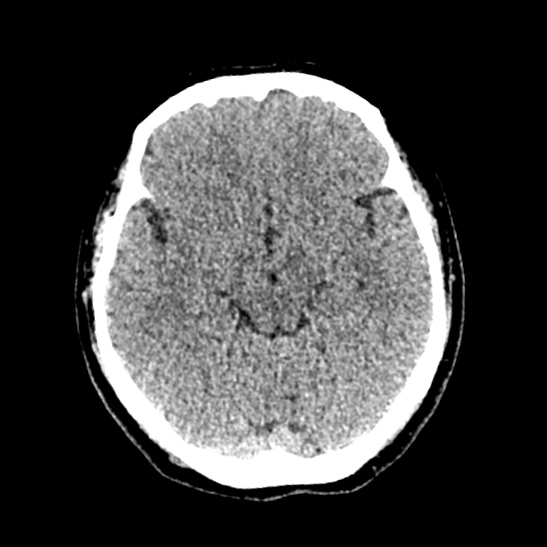 Cerebellopontine angle meningioma (Radiopaedia 53561-59592 Axial non-contrast 27).jpg