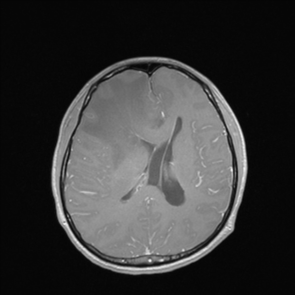Cerebral abscess (Radiopaedia 24212-24478 Axial T1 C+ 37).jpg