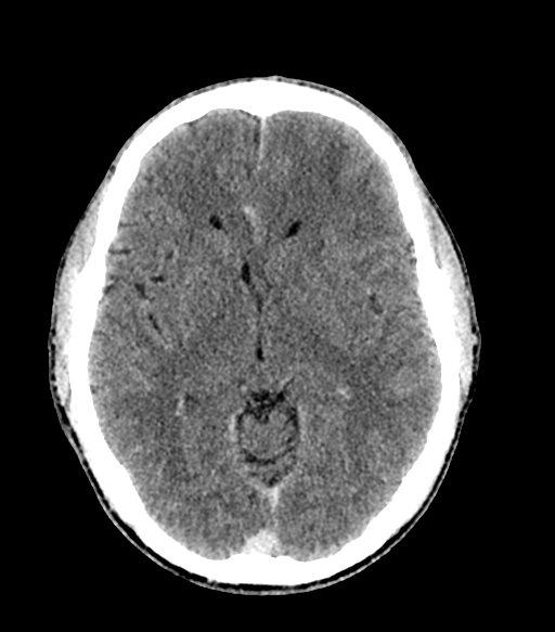 Cerebral abscess (Radiopaedia 57774-64741 Axial C+ delayed 34).png