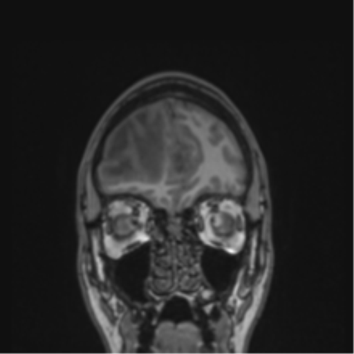 Cerebral abscess (Radiopaedia 60342-68009 Coronal T1 46).png