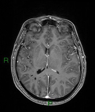 Cerebral abscess and subdural empyema (Radiopaedia 84436-99779 Axial T1 C+ 41).jpg