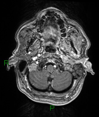 Cerebral abscess and subdural empyema (Radiopaedia 84436-99779 Axial T1 C+ 77).jpg