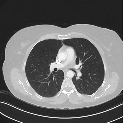 Cerebral abscess from pulmonary arteriovenous malformation (Radiopaedia 86275-102292 Axial lung window 28).png