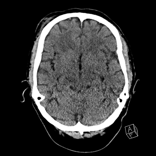 Cerebral abscess with ventriculitis (Radiopaedia 78965-91876 Axial non-contrast 20).jpg