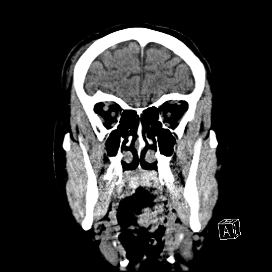 File:Cerebral abscess with ventriculitis (Radiopaedia 78965-91876 B 13).jpg