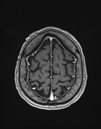 Cerebral amyloid angiopathy-related inflammation (Radiopaedia 58270-65377 Axial T1 C+ fat sat 128).jpg