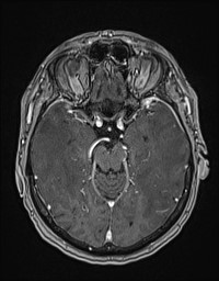 Cerebral amyloid angiopathy-related inflammation (Radiopaedia 58270-65377 Axial T1 C+ fat sat 52).jpg