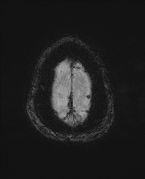 File:Cerebral amyloid angiopathy-related inflammation (Radiopaedia 74836-85849 Axial SWI 67).jpg