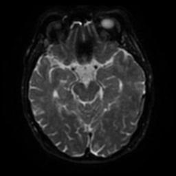 Cerebral amyloid angiopathy (Radiopaedia 28698-28978 Axial DWI 39).jpg