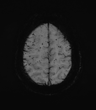 File:Cerebral amyloid angiopathy (Radiopaedia 46082-50433 Axial SWI MIP 66).png