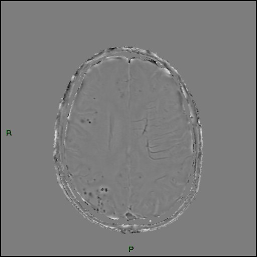 Cerebral amyloid angiopathy (Radiopaedia 77506-89664 H 68).jpg
