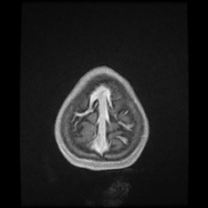 Cerebral and spinal tuberculosis (Radiopaedia 90489-107837 Axial T1 C+ 178).jpg