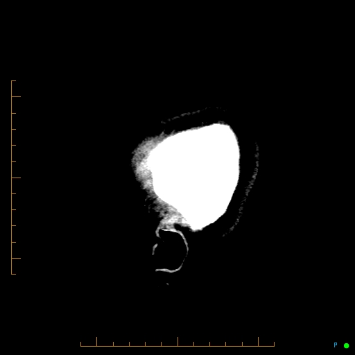 Cerebral arteriovenous malformation (AVM) (Radiopaedia 78162-90706 A 5).jpg